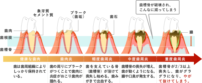 歯周病の進行