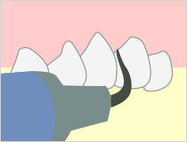 歯周病とは？