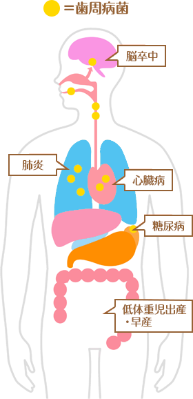 歯周病