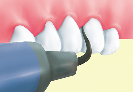 歯石・歯垢除去