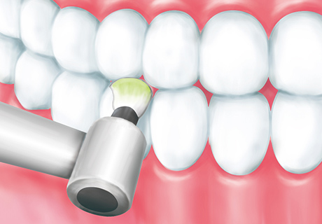 歯石・歯垢除去