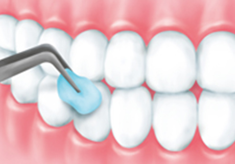 歯石・歯垢除去